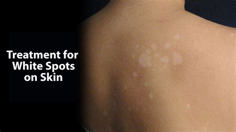 Treatment For White Spots On Skin Youtube