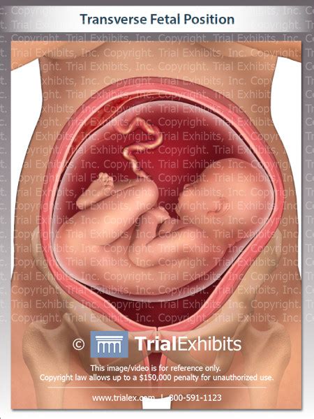Transverse Fetal Position Trial Exhibits Inc