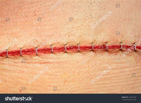 Modern Surgical Suture Stock Photo 129331484 Shutterstock