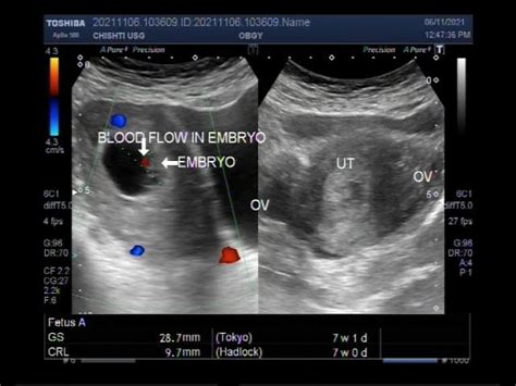 7 Weeks Pregnant Ultrasound