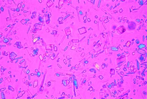 Identification Of Crystals In Synovial Fluid Annals Of The Rheumatic