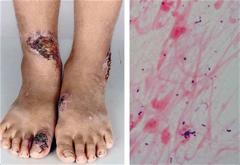 Skin Ulcers In A Returned Traveller The Lancet