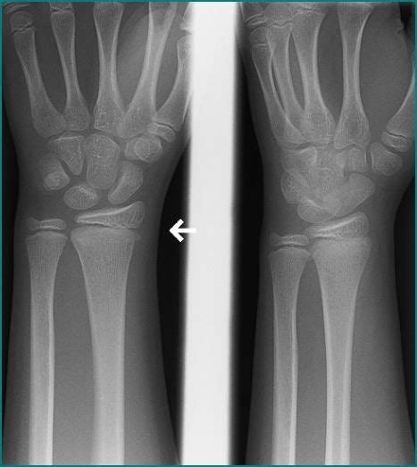 Is There A Spilled Teacup On This 4 View Wrist X Ray To