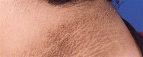 Velvety Neck Skin Treatment In Chandigarh Acanthosis Nigricans Causes