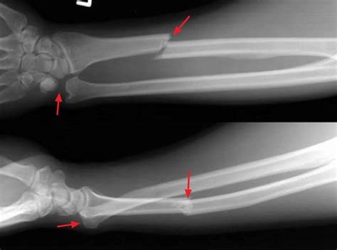 Galeazzi Fracture Causes Symptoms Diagnosis Treatment And Prognosis