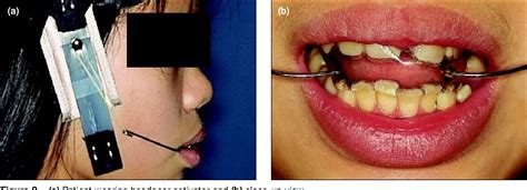 Figure 2 From Modified Trimming Of The Van Beek Headgear Activator