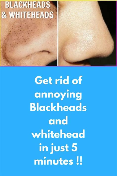 Best Remedies To Get Rid Of Whiteheads On Face And Nose In 2020