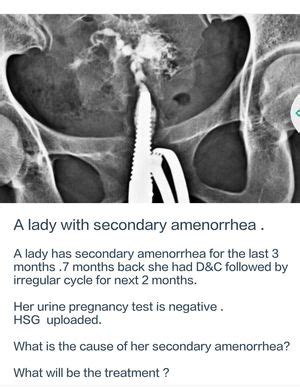 Amenorrhea Medizzy