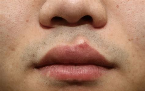 Sebaceous Cyst On Lips