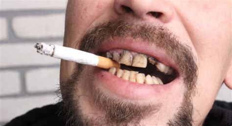 tobacco use and oral health avoid for better tomorrow