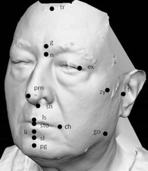 Scielo Brasil Three Dimensional Soft Tissue Facial Morphometry In Caucasian Obese Adults