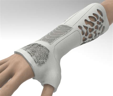 Custom Orthopaedic Arm Cast Design On Behance