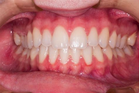 The Reason Why Gums May Look White Balsall Common Dental