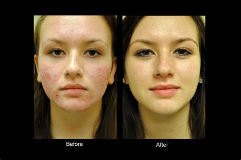 Bellevue Laser And Cosmetic Center Acne