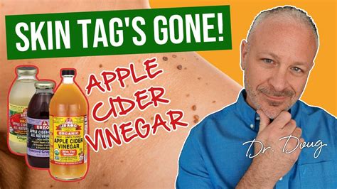 Home Remedies To Remove Skin Tags With Apple Cider Vinegar