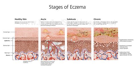 Stages Of Eczema Labelled Medical Stock Images Company