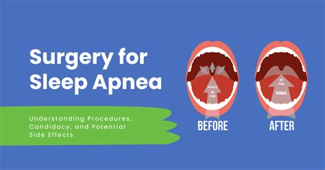 Is Sleep Apnea Surgery Right For You Pros Cons Alternatives