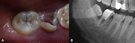 Endodontic Management Of An Autotransplanted Mandibular Third Molar