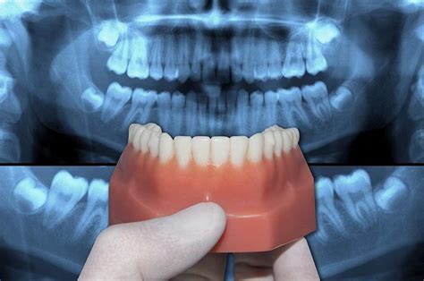 Maybe you would like to learn more about one of these? Posterior Crossbite Treatment and Correction - Healthrow.net