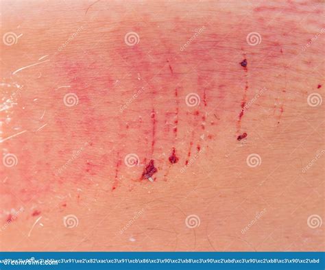 Scratch Lesion Caused By The Accident On Leg Skin Stock Image Image