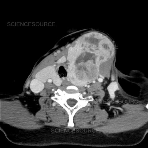 Photograph Large Thyroid Goiter Ct Science Source Images