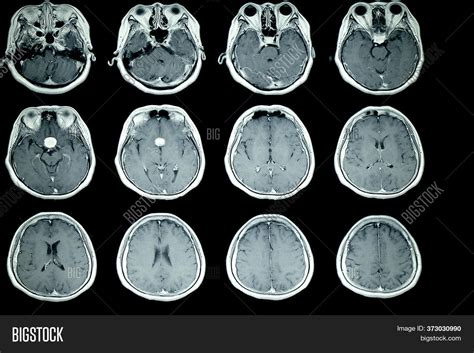 Mri Scan Patient Brain Image And Photo Free Trial Bigstock