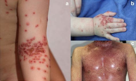 Characteristic Monomorphic Eruptions Of Eczema Herpeticum On Arm A