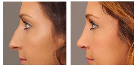 How Rhinoplasty Surgery Is Done Whole Procedure Healthpulls