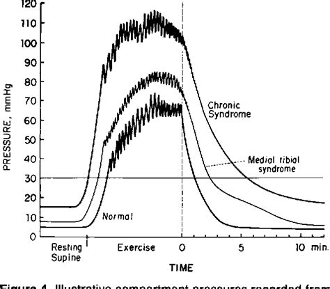 The Medial Tibial Stress Syndrome Semantic Scholar