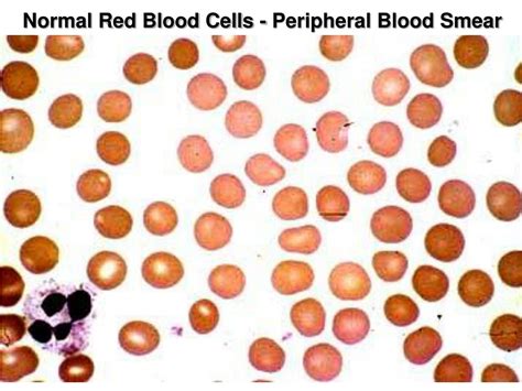 Ppt Normal Red Blood Cells Peripheral Blood Smear