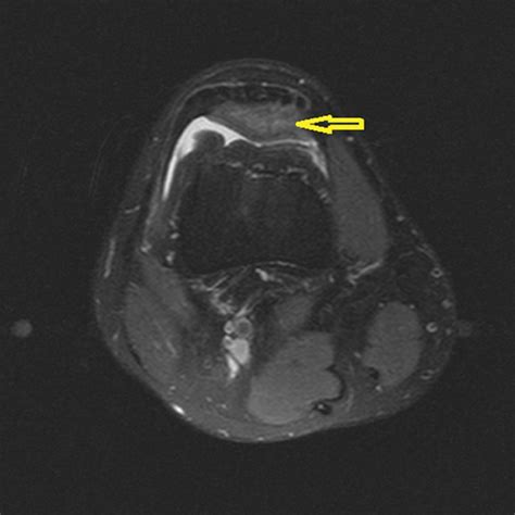 Quadriceps Fat Pad Impingement Syndrome Mri Findings Bmj Case Reports