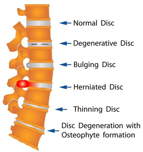 herniated disc south florida back to mind chiropractic