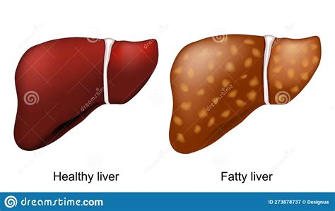 Fatty Liver Disease Healthy Liver And Hepatic Steatosis Stock