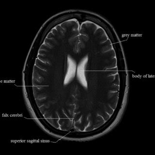 Axial View Of Brain