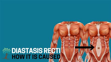 What Causes Diastasis Recti Diastasis Ed 3 Youtube
