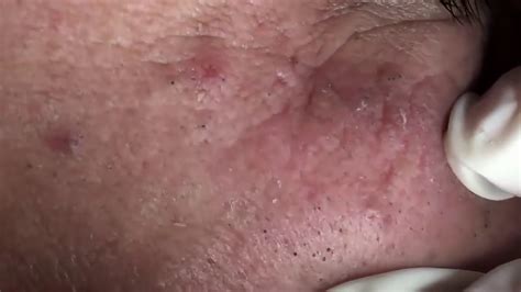 Blackheads Removal 6 Youtube
