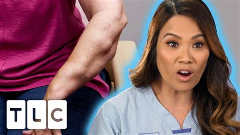 dr lee removes 68 lipomas from a patient s arms dr pimple popper youtube
