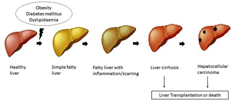 Fatty Liver Disease A Condition Caused By Modern Day Lifestyle Atlas