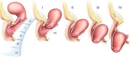 Grades Of Uterine Prolapse Vinmec