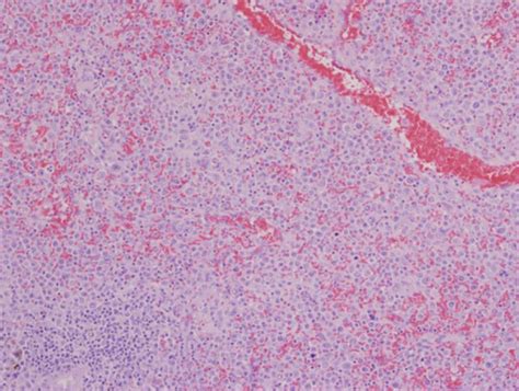 Pleomorphic Mantle Cell Lymphoma Involves The Spleen A Diffuse