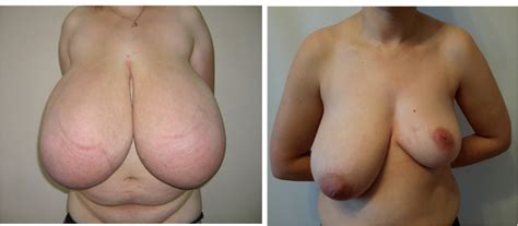 Abnormal Breasts 31 Pics Xhamster