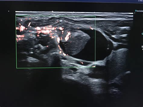 Vietnamese Medic Ultrasound Case Ultrasound Of A Cystic Neck Mass