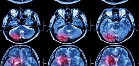 New Potential Approach Against Fatal Childhood Brain Cancer