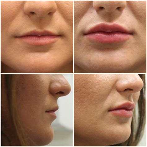 Lip Augmentation Lip Fillers Lip Injections