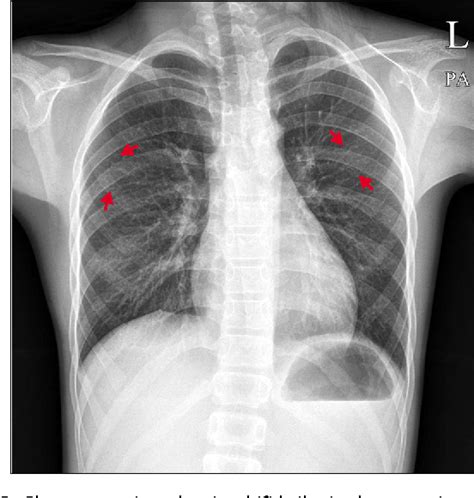 Figure 2 From Nevoid Basal Cell Carcinoma Syndrome A Case Report And