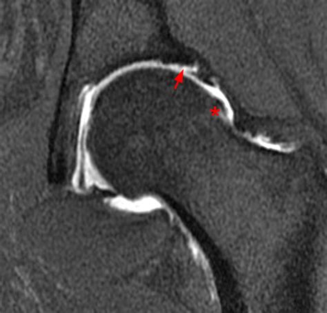 Postoperative Hip Mri In Patients Treated For Fai Radsource