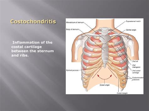 Costochondritis