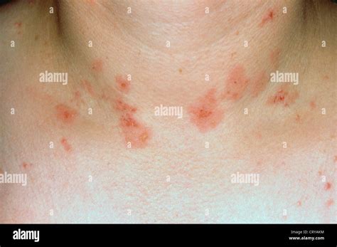 Dermatitis Herpetiformis Stock Photo Alamy