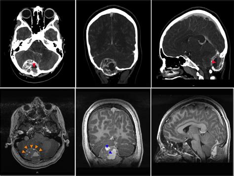 Cureus Hemorrhagic Giant Cell Tumor Of The Occipital Skull Base A