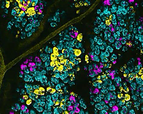 How Cancer Cells Grow And Spread In Colon Tissue